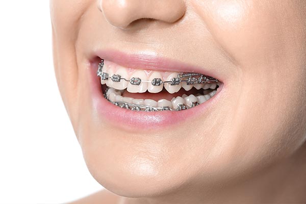 The image shows a person with braces smiling at the camera.