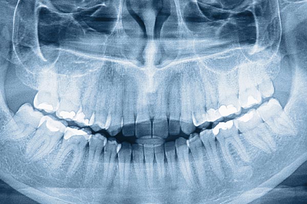 The image shows a lateral view of a human skull with an open mouth, revealing teeth and the upper palate, against a blue background.