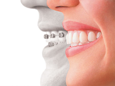 The image features a split-screen comparison of a person s teeth before and after dental treatment, showcasing the difference between natural teeth and those with braces.